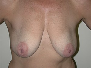 Breast Lift before and after - before