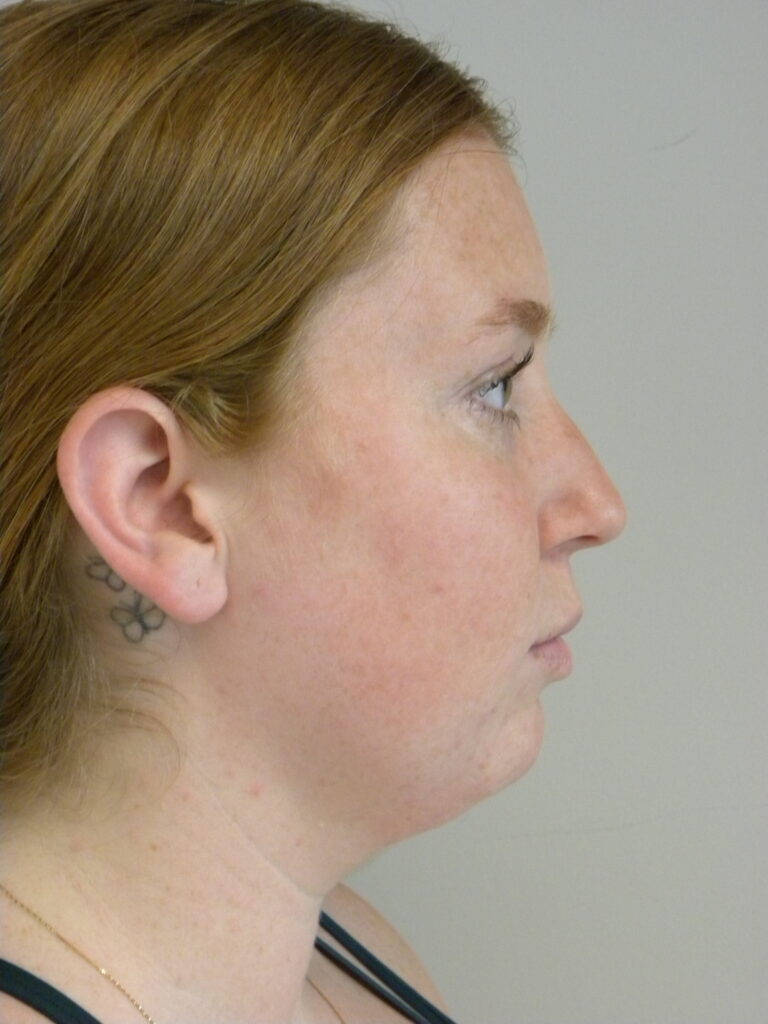 Chin before and after - before