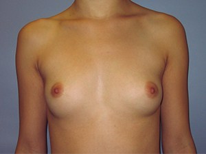Breast Augmentation before and after - before