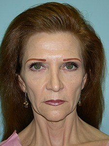Facelift before and after - before