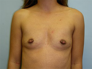Breast Augmentation before and after - before