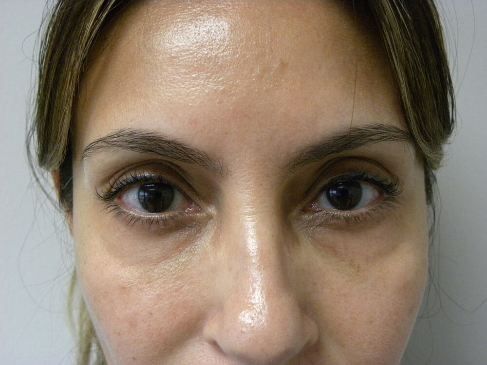Blepharoplasty before and after - before