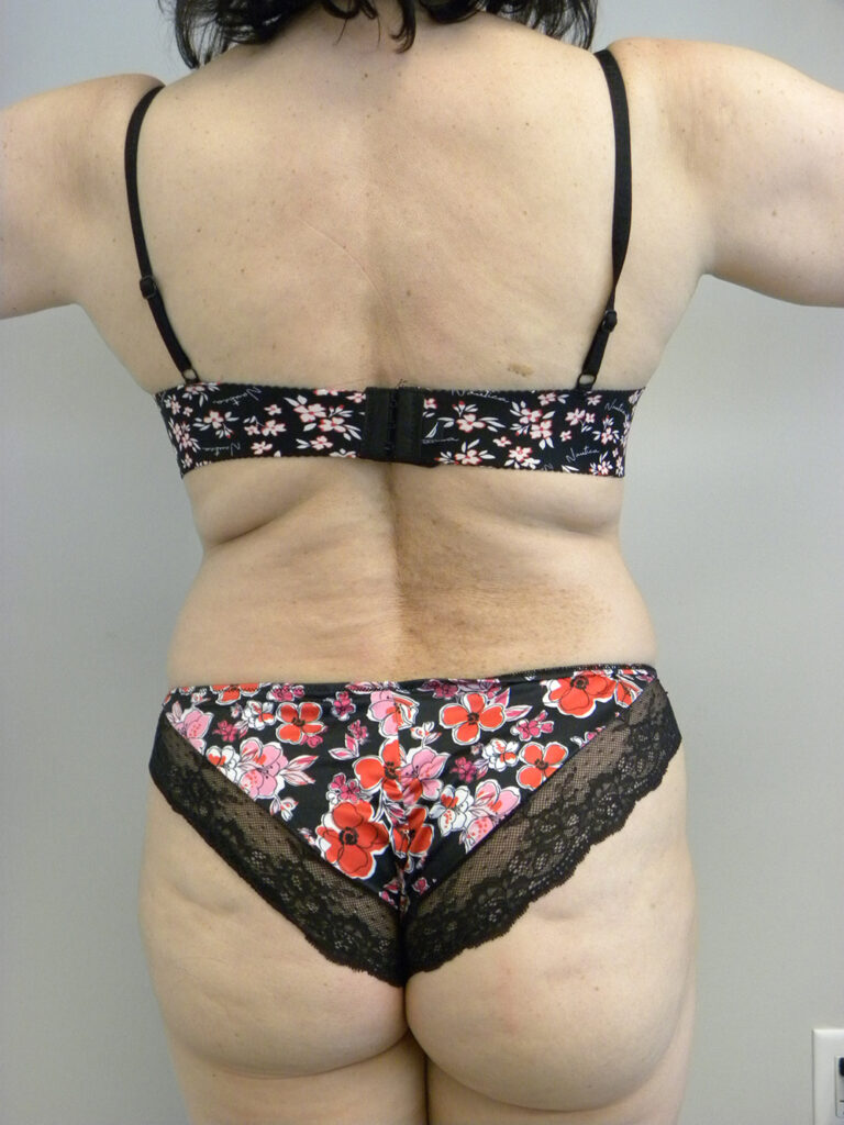Liposuction before and after - before