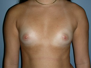 Breast Augmentation before and after - before