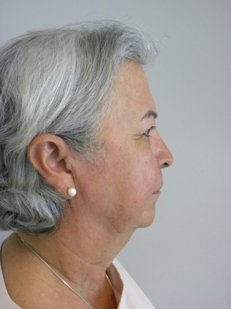 Blepharoplasty before and after - before
