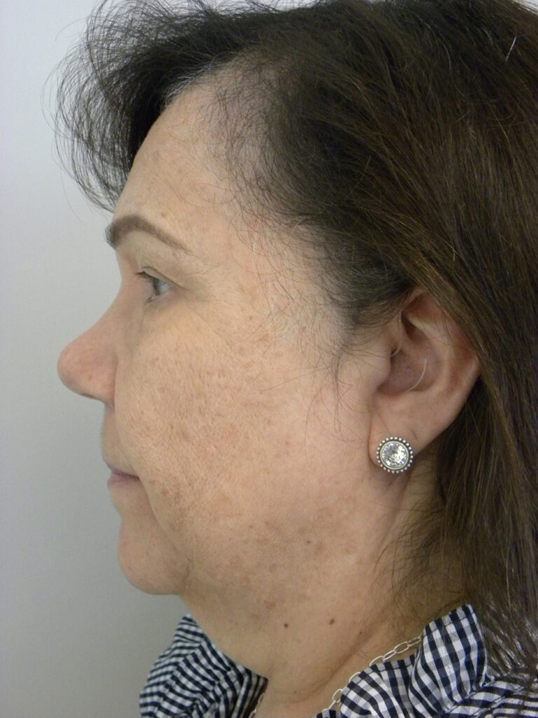 Blepharoplasty before and after - before