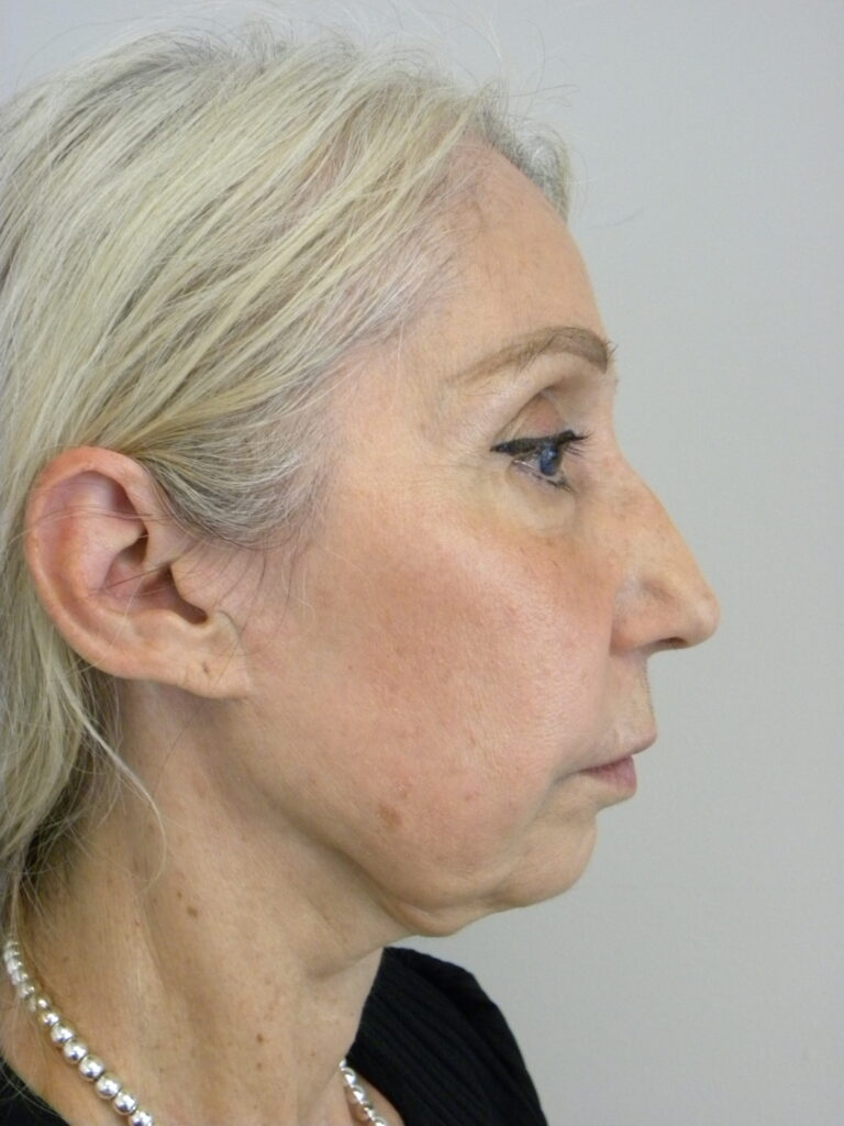 Facelift before and after - before