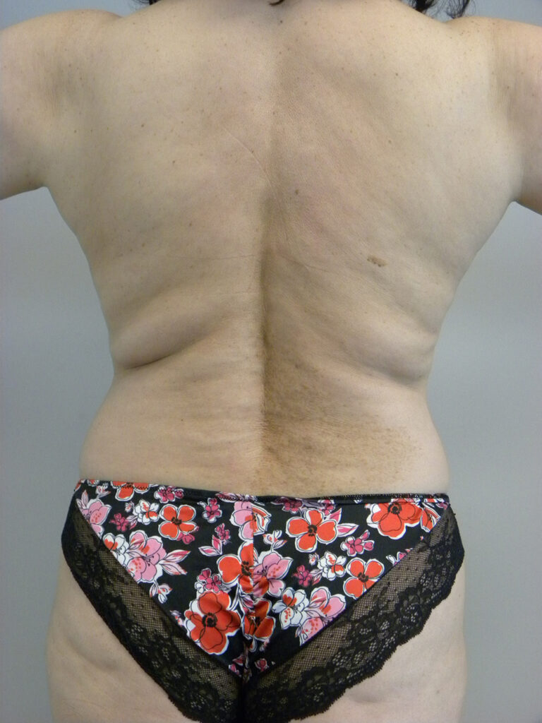 Liposuction before and after - before