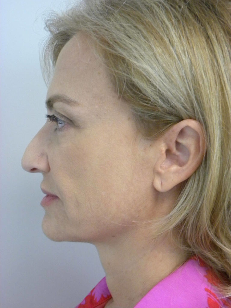 Facelift before and after - before