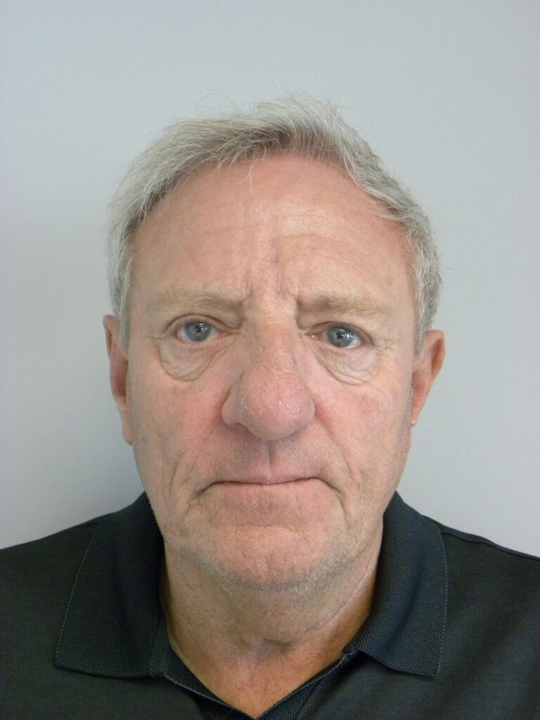 Facelift before and after - before