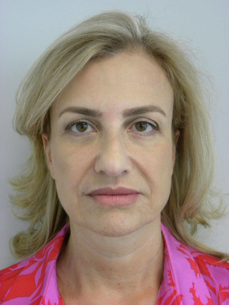 Facelift before and after - before