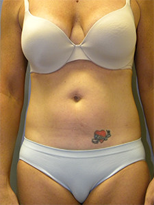 Liposuction before and after - before