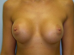 Breast Augmentation before and after - before
