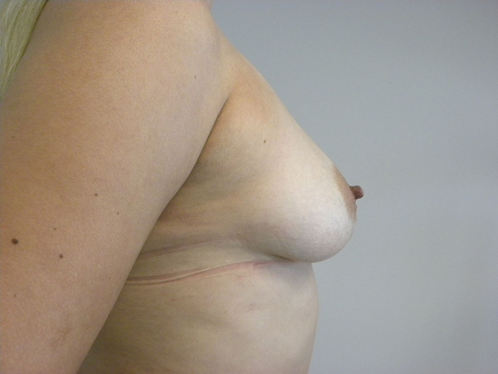 Breast Augmentation before and after - before