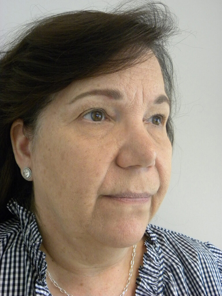 Blepharoplasty before and after - before