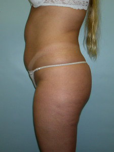 Liposuction before and after - before