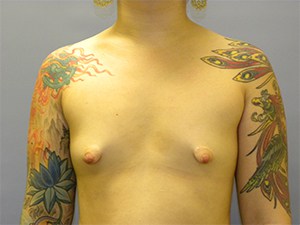 Breast Augmentation before and after - before