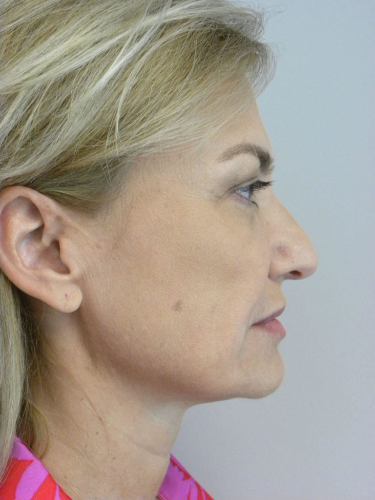 Facelift before and after - before