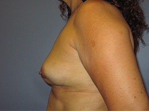 Breast Augmentation before and after - before