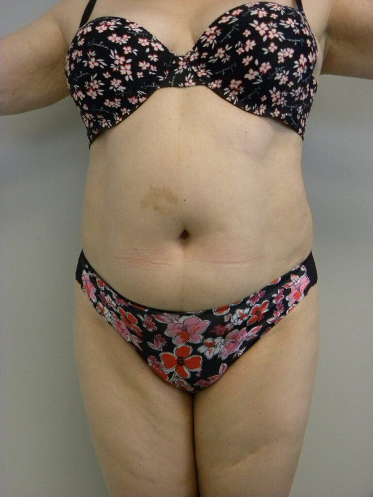 Liposuction before and after - before