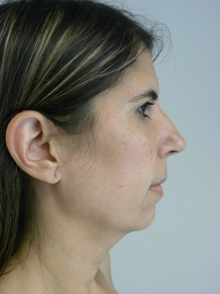 Chin before and after - before