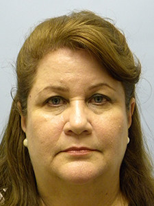 Facelift before and after - before