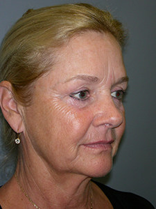 Facelift before and after - before
