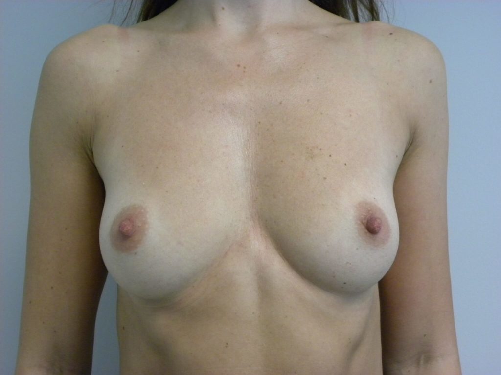 Breast Augmentation before and after - before