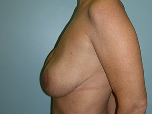 Breast Augmentation before and after - before