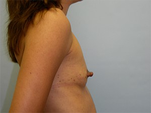 Breast Augmentation before and after - before