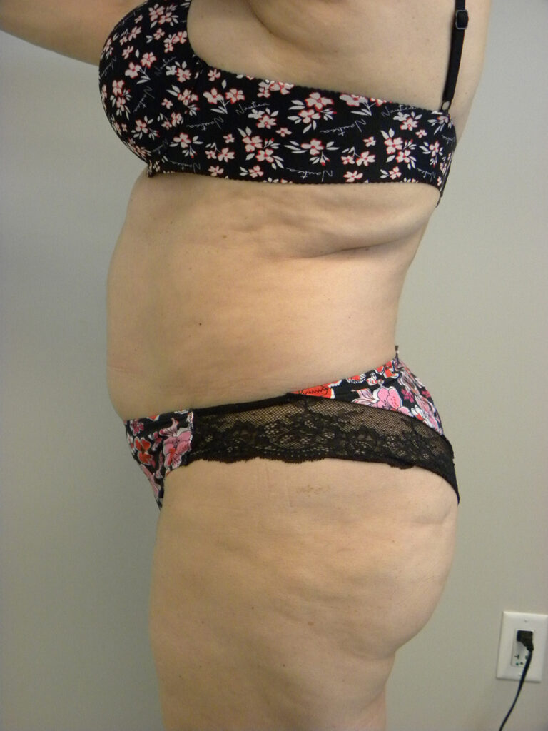 Liposuction before and after - before