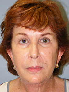 Facelift before and after - before