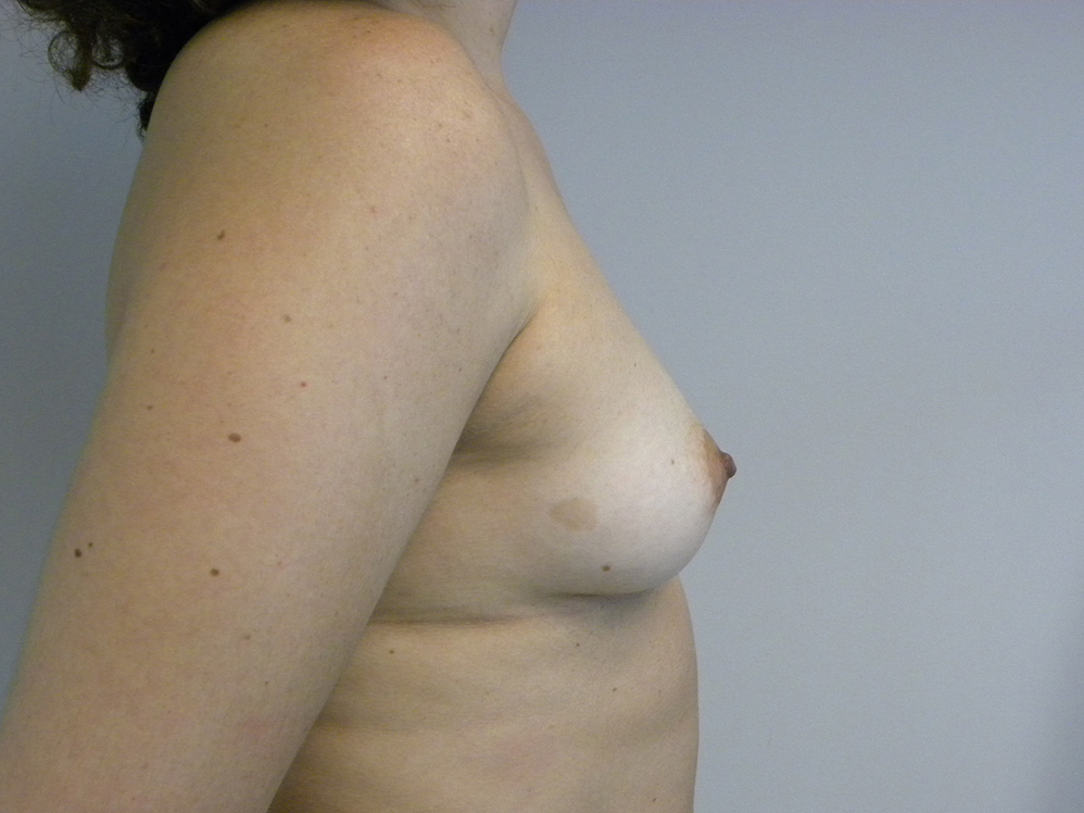Breast Augmentation before and after - before
