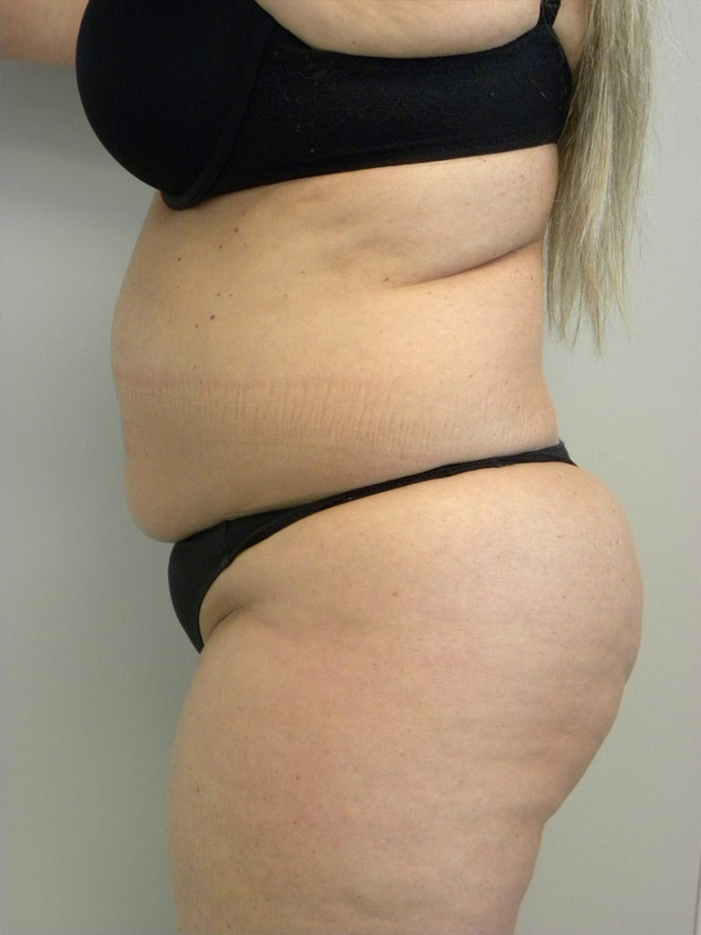 Liposuction before and after - before