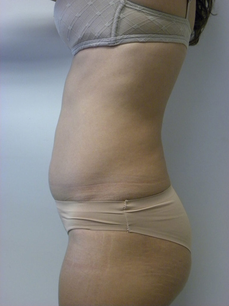 Liposuction before and after - before