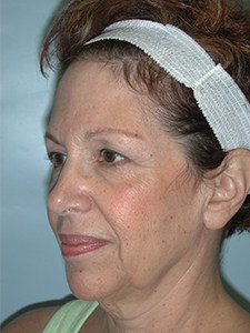 Facelift before and after - before