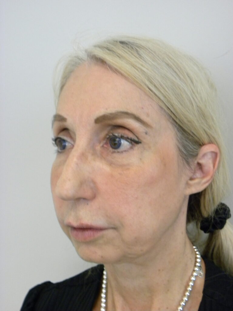 Facelift before and after - before