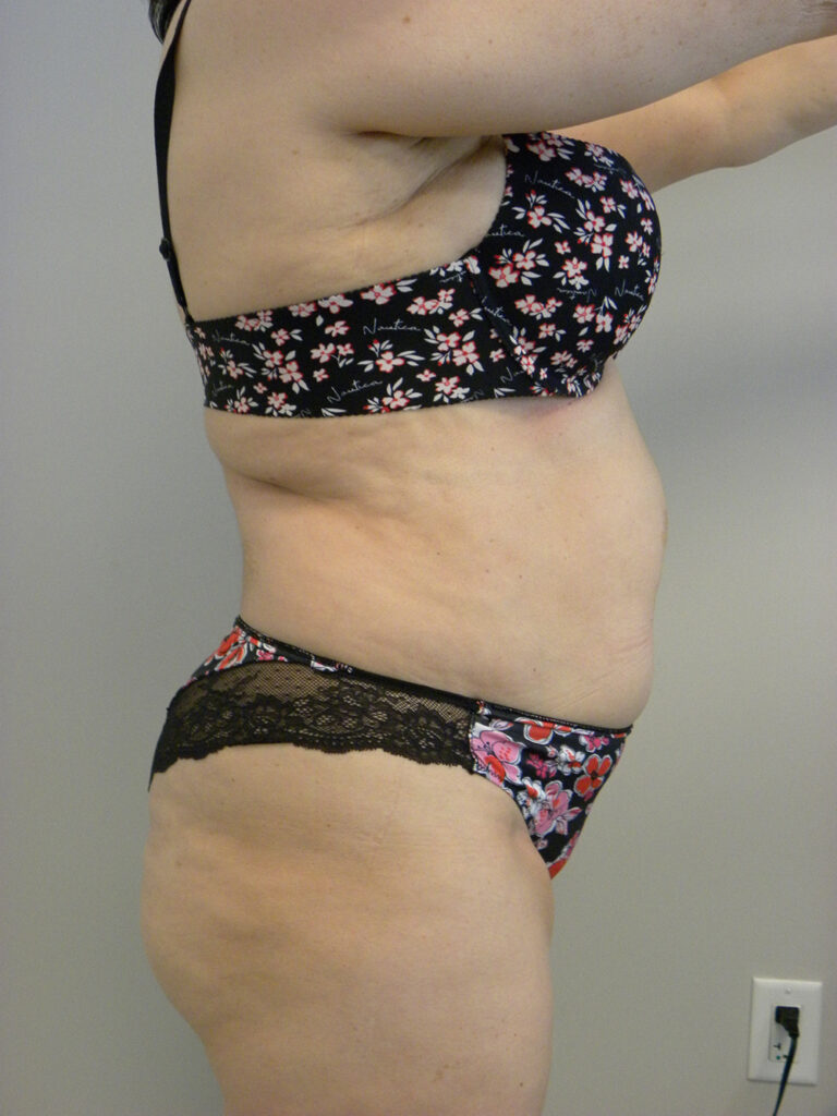 Liposuction before and after - before