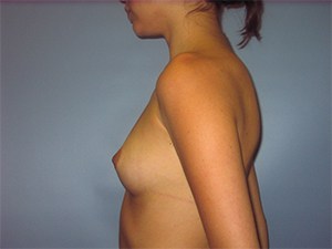 Breast Augmentation before and after - before