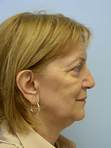 Facelift before and after - before