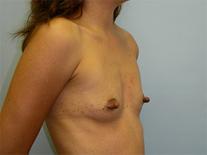 Breast Augmentation before and after - before