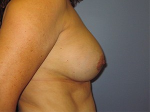 Breast Augmentation before and after - before
