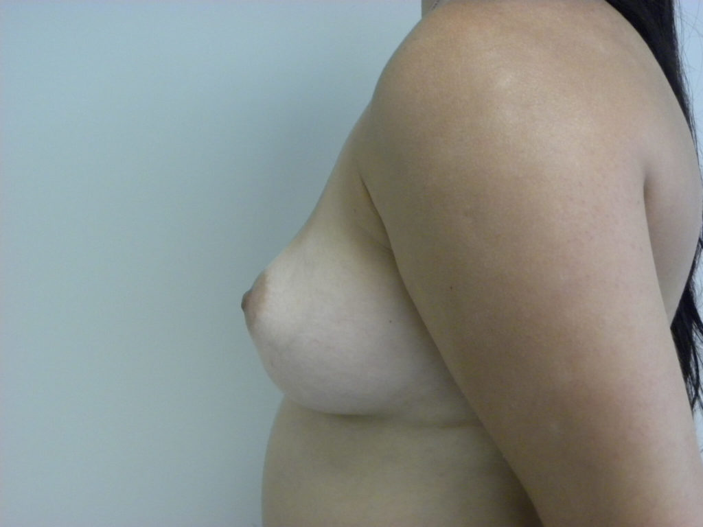Breast Augmentation before and after - before