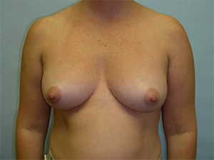 Breast Augmentation before and after - before
