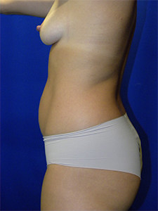 Liposuction before and after - before
