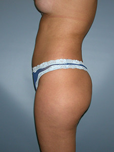 Liposuction before and after - before