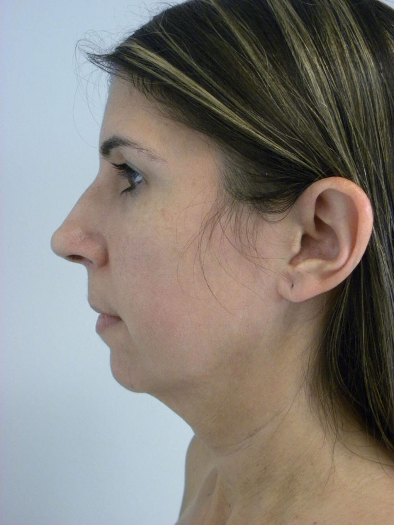 Chin before and after - before
