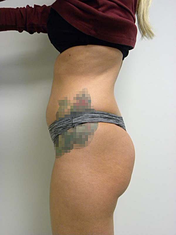 Liposuction before and after - before