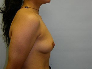 Breast Augmentation before and after - before