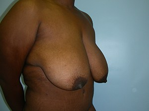Breast Reduction before and after - before